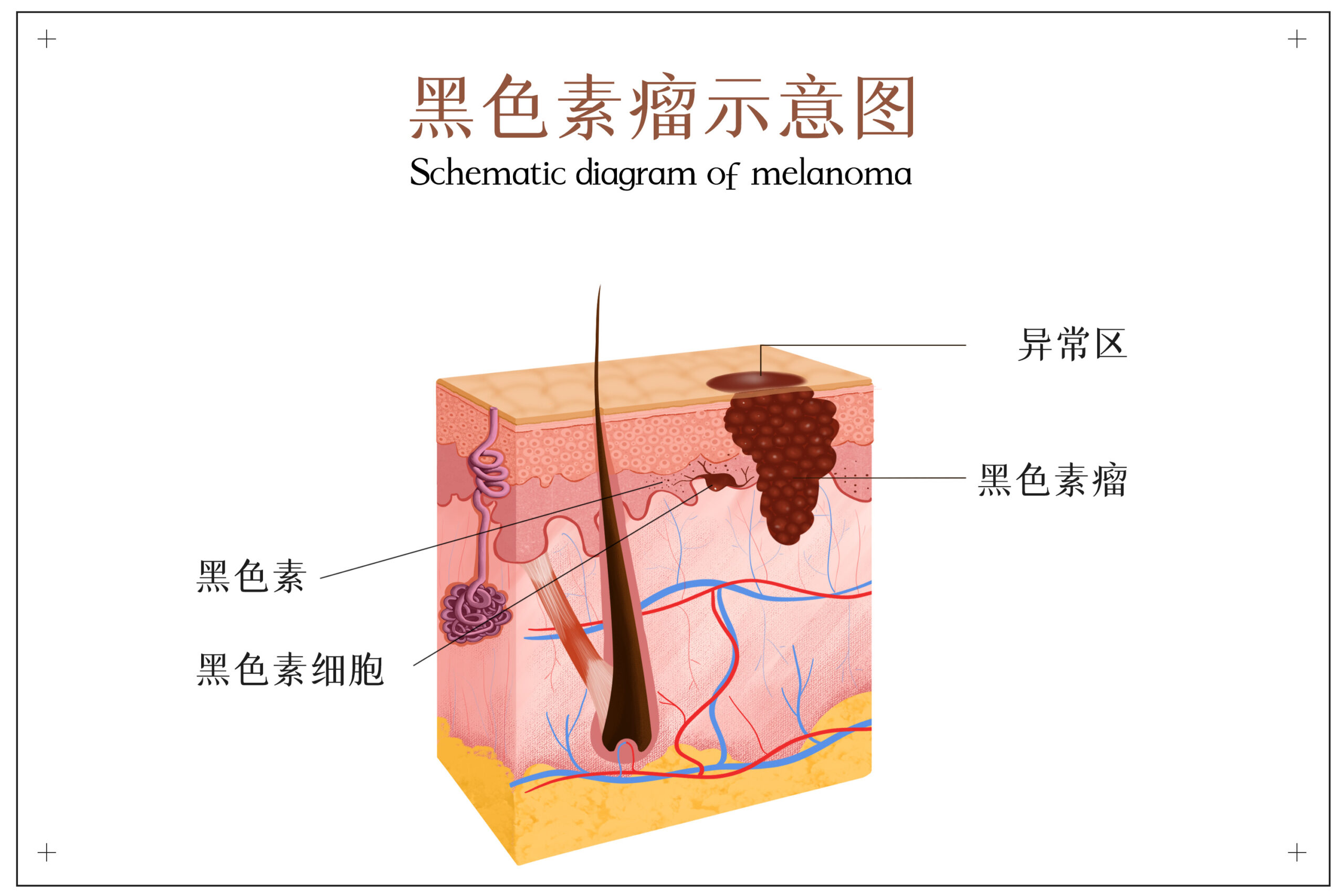 身上长这种痣，当心是瘤！哪些保险能赔？插图2